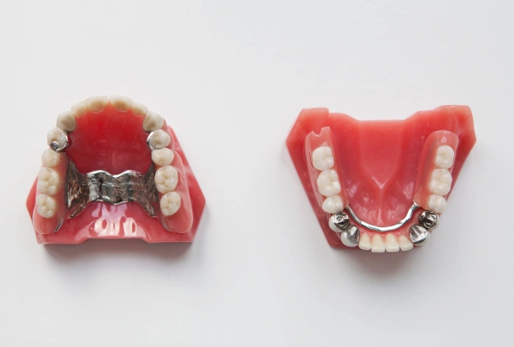 Dental models showing upper and lower palatal expanders on teeth